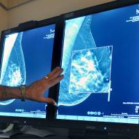 A radiologist in 2012 compares an image from an earlier, 2-D technology mammogram to the new 3-D Digital Breast Tomosynthesis mammography in Wichita Falls, Texas. The technology can detect much smaller cancers earlier. In guidelines published Tuesday, the American Cancer Society revised its advice on who should get mammograms and when, recommending annual screenings for women at age 45 instead of 40 and switching to every other year at age 55. American Cancer Society now urges fewer mammograms and later age to start screening