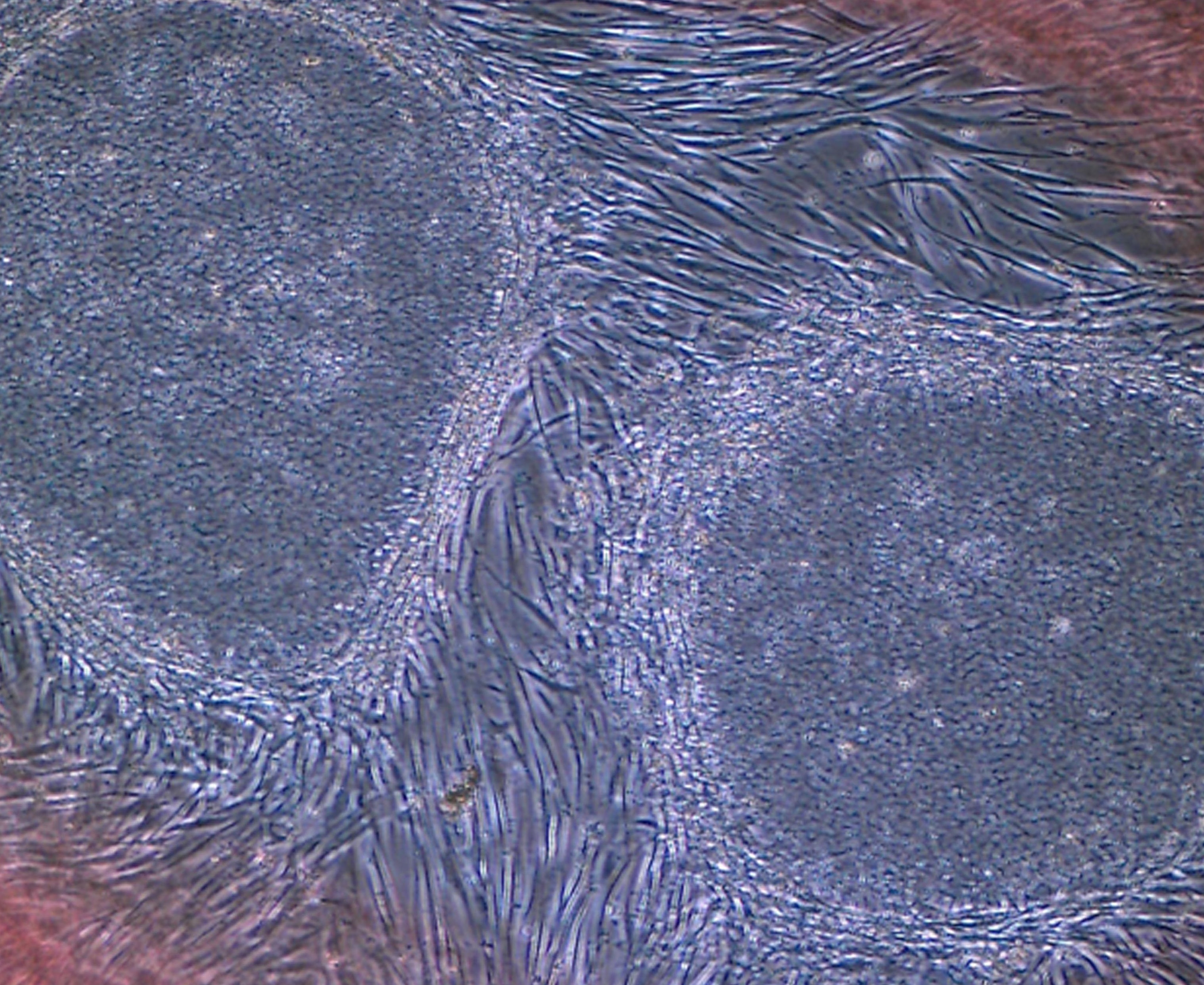 First iPS cell transplant patient makes progress one year on | The ...