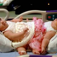 This Sunday photo provided by Driscoll Children's Hospital shows conjoined twin sisters Scarlett (left) and Ximena Hernandez-Torres at Dirscoll Children's Hospital in Corpus Christi, Texas. Doctors Tuesday started an operation to separate the two 10-month-old sisters born conjoined below the waist. Surgery starts in Texas to separate infant conjoined twins