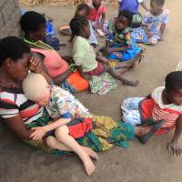 Edna Cedrick, 26, holds her surviving albino son on May 24 after his twin brother who had albinism was snatched from her arms in a violent struggle in Machinga about 200 km north east of Blantyre Malawi. Cedrick says she is haunted daily by images of the decapitated head of her 9 year old son. Malawi urged to 'stop burying its head in the sand' as albino abductions, slayings for body parts surges