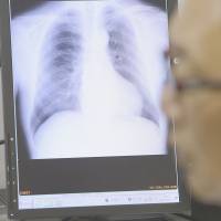 Soaring cost of care: Expensive drugs like Opdivo, a lung cancer treatment that costs a whopping ¥1.33 million a dose, are asking difficult questions of Japan's health insurance system. Expensive new drugs put strain on Japan's health system