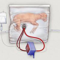 This illustration shows a fluid-filled incubation system that mimics a mother’s womb, being developed to support extremely premature babies until their lungs and other organs can handle regular medical care. Experimental artificial womb brings hope for youngest premature babies