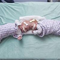 This September 2016 photo provided by the Children’s Hospital of Philadelphia shows conjoined twin girls Abby (right) and Erin at the Children’s Hospital of Philadelphia in Philadelphia. Hospital officials said Tuesday surgeons successfully separated the 10-month-old twins June 6 during an 11-hour surgery. In 11-hour surgery, Philadelphia hospital separates 10-month-old twins conjoined at their heads