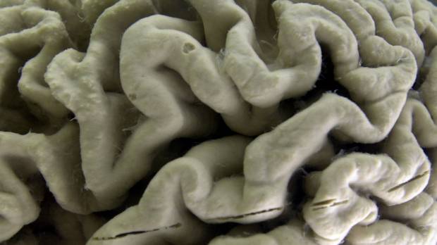 A section of a human brain with Alzheimer’s disease is displayed at the Museum of Neuroanatomy at the University at Buffalo in New York in 2003. There are no proven ways to stave off Alzheimer’s, but a new report raises the prospect that avoiding nine risks starting in childhood just might delay or even prevent about a third of dementia cases. Lancet report gives advice on possible ways to delay onset of dementia