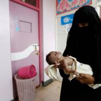 A woman holds her malnourished son at a malnutrition treatment center in Sanaa Monday. ICRC chief visits besieged Taiz on Yemen's front lines to assess humanitarian crisis