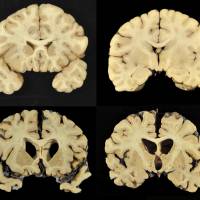This combination of photos provided by Boston University shows sections from a normal brain (top) and from the brain of former University of Texas football player Greg Ploetz (bottom) in stage IV of chronic traumatic encephalopathy. According to a report released on Tuesda by the Journal of the American Medical Association, research on the brains of 202 former football players has confirmed what many feared in life — evidence of chronic traumatic encephalopathy, or CTE, a devastating disease in nearly all the samples, from athletes in the NFL, college and even high school. Degenerative brain damage found in 110 of 111 deceased NFL players: study
