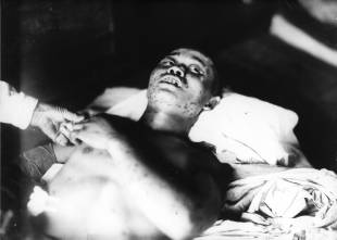 A 21-year-old soldier exposed within 1km of the hypocenter, with subcutaneous hemorrhage spots. He died less than a month after the bombing. | HIROSHIMA PEACE MEMORIAL MUSEUM / GONICHI KIMURA