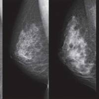 These mammograms show breasts with differing densities, (from left) ranging from an extreme fatty breast, one with scattered areas of density, a heterogeneously dense type and an extremely dense type. | NPO BREAST CANCER IMAGING NETWORK