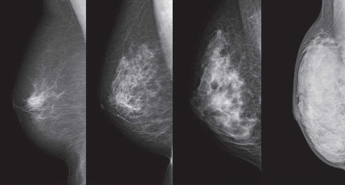 These mammograms show breasts with differing densities, (from left) ranging from an extreme fatty breast, one with scattered areas of density, a heterogeneously dense type and an extremely dense type. | NPO BREAST CANCER IMAGING NETWORK