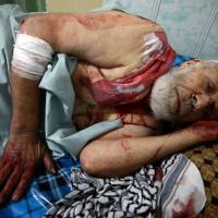 A wounded man lies in a Douma hospital after heavy shelling in the rebel-held besieged town of Douma, eastern Ghouta in Damascus Sunday. | REUTERS