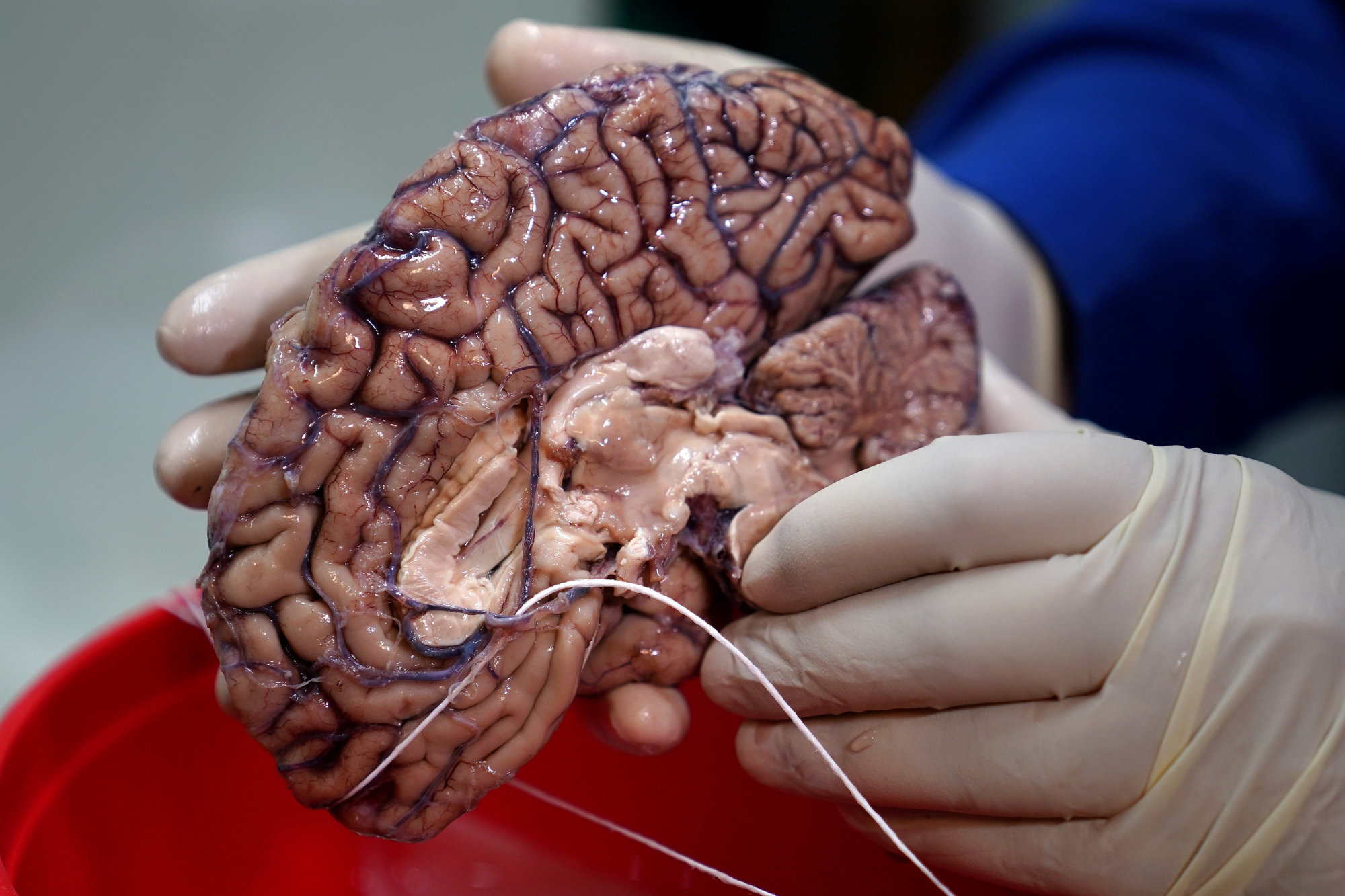 A doctor holds a human brain at a brain bank in the Bronx borough of New York City. | REUTERS
