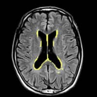 Possible brain abnormalities detected by an AI-driven image analyzer are marked in yellow in this MRI scan. | LPIXEL / VIA KYODO
