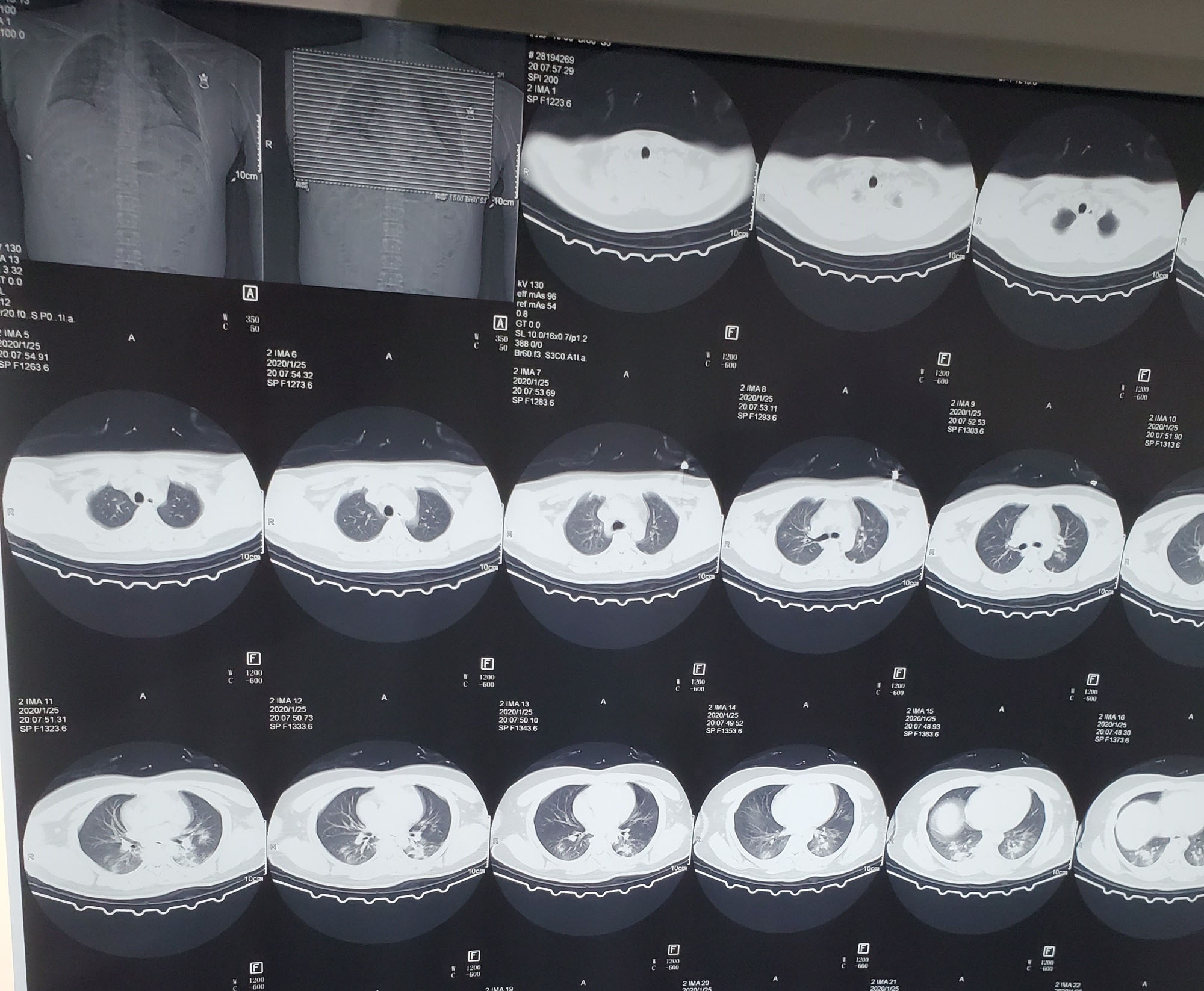 A CT scan of the lungs of 'Tiger Ye' after his condition deteriorated at Wuhan Pulmonary Hospital on Jan. 25. | TIGER YE / VIA BLOOMBERG