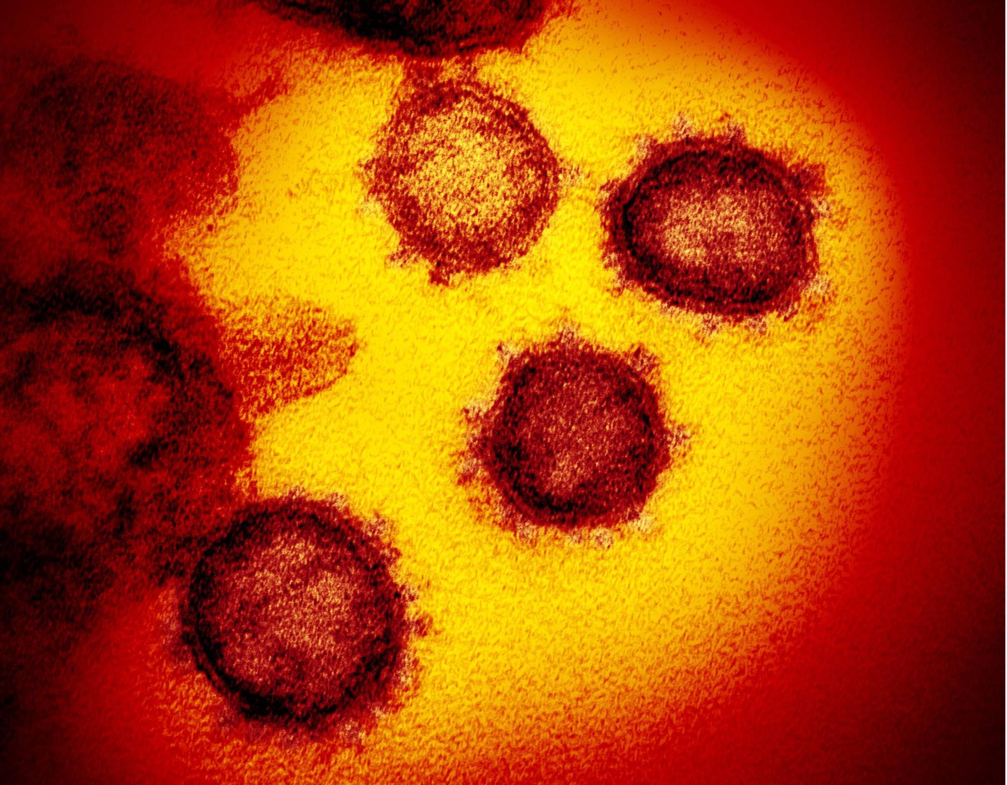 A sample of the novel coronavirus is shown in an electron micrograph. | U.S. NATIONAL INSTITUTE OF ALLERGY AND INFECTIOUS DISEASES / VIA KYODO