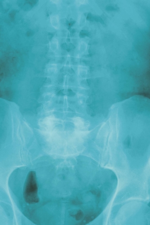 X marks the spot: An x-ray shows a patient's pelvic region. | GETTY IMAGES