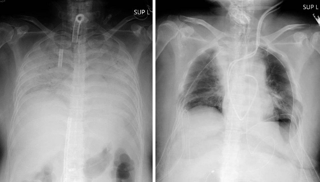 X-ray images show the chest area of a COVID-19 patient who suffered lung damage before (left) and after a transplant operation (right). The dark areas show the transplanted lung tissue. | KYOTO UNIVERSITY HOSPITAL / VIA KYODO