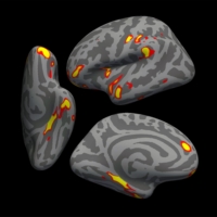 An image provided by the University of Oxford and the U.S. National Institutes of Health shows a digital model of a human brain showing the parts of the brain that lost the most gray matter in the 401 COVID-infected participants in a study, in red-yellow. | G. DOUAUD, ANDERSON WINKLER AND SAAD JBABDI / UNIVERSITY OF OXFORD AND NIH VIA THE NEW YORK TIMES