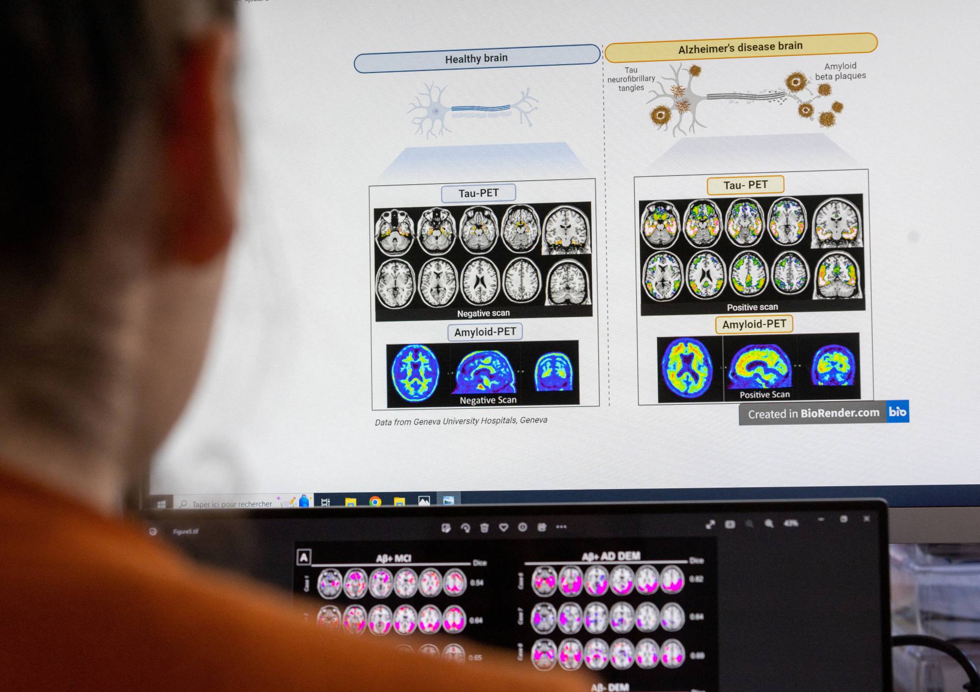 Brain scans at the Memory Centre at the Department of Readaptation and Geriatrics of the University Hospital (HUG) in Geneva, Switzerland | REUTERS