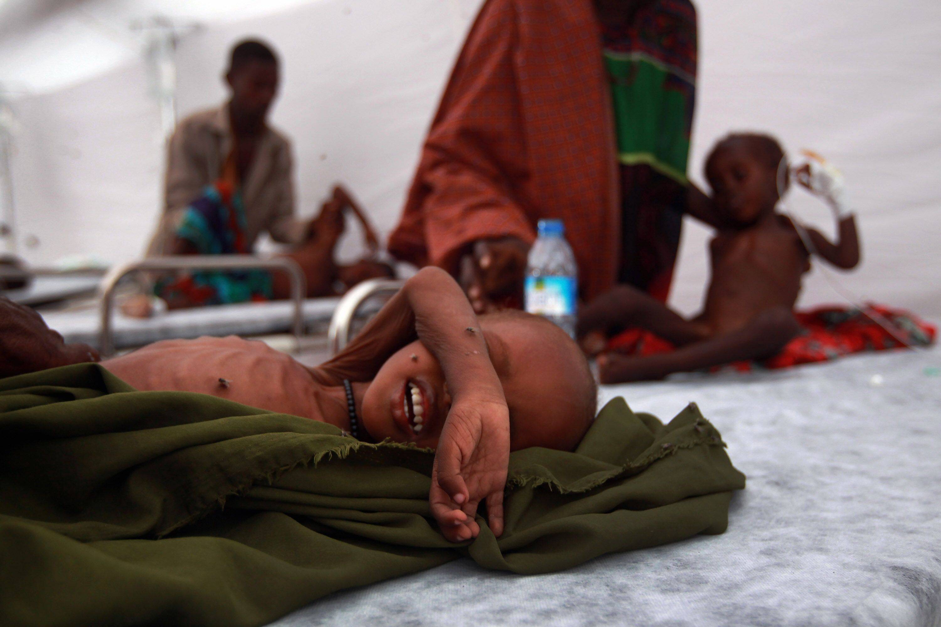 Children receive medical treatment at a field hospital in Mogadishu, Somalia. The lingering fallout from the pandemic and Russia’s war in Ukraine means about 735 million people went undernourished in 2022. | GETTY IMAGES / VIA BLOOMBERG