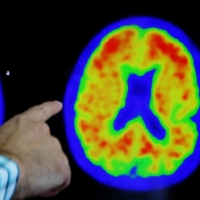 The proposed guidelines embrace a numerical staging system assessing Alzheimer\'s disease progression similar to the one used in cancer diagnoses. | REUTERS