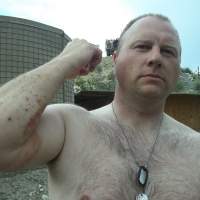 Shrapnel sores: Army Pfc. Ted Daniels shows where shrapnel hit his arm during an April 2012 firefight in Afghanistan. | THE WASHINGTON POST