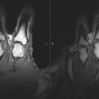 These MRI images show what happens when someone cracks their knuckles. At left are normal metacarpophalangeal joints. At right, a dark intra-articular void is visible in a joint of the index finger following a cracking event. | REUTERS