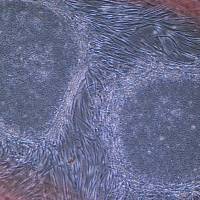 This image shows iPS cells from a female patient in her 70s who underwent treatment a year ago using iPS-derived cells. First iPS cell transplant patient makes progress one year on