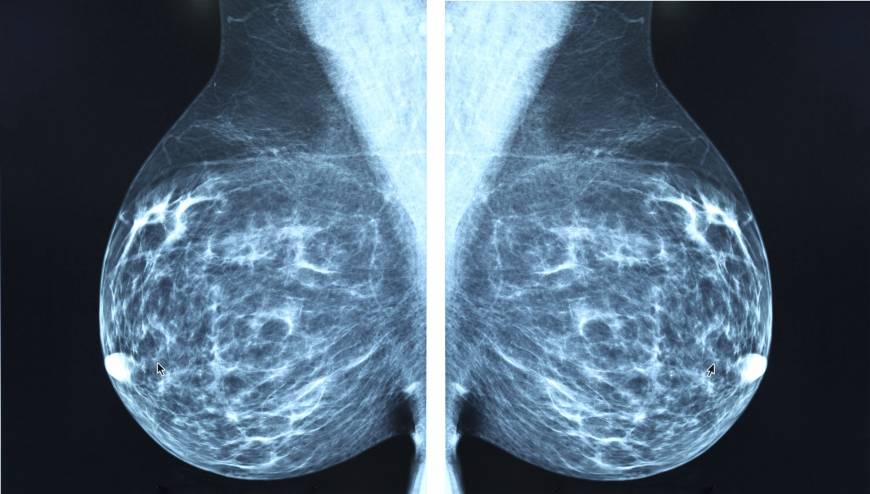 Image result for mammogram images