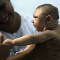Therapist Rozely Fontoura holds Juan Pedro, who has microcephaly, in Recife, Brazil, on Saturday. When Daniele Santos gave birth to a baby boy with microcephaly, a serious birth defect linked to the Zika infection, she was distraught. She was left to look after Juan Pedro alone after her husband left. In addition to traditional treatment at a hospital in Recife, Santos is learning therapeutic massage from an NGO to help alleviate Pedro\'s symptoms. | REUTERS