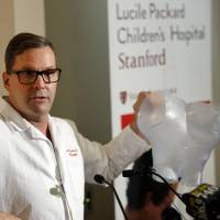 Plastic and reconstructive surgeon Peter Lorenz holds up a 3-D model of the abdomen area of conjoined California twins Eva and Erika Sandoval, before their separation, during a news conference at the Lucile Packard Children\'s Hospital Thursday in Palo Alto, California. The conjoined twins have become two separate toddlers following a marathon surgery and are recovering \"quite well,\" officials said Thursday. | AP