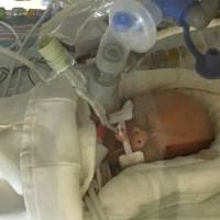 In this Sept. 8 photo provided by Sonya Nelson, Life Lynn DeKlyen lies in the Neonatal Intensive Care Unit of the University of Michigan Hospital in Ann Arbor. Sonya Nelson says her niece, Life Lynn DeKlyen, died Wednesday evening at the hospital. Her mother, Carrie DeKlyen, who sacrificed the chance to prolong her life to give birth to Life Lynn, her sixth child, died Sept. 9. Premature baby whose mom chose giving birth over chemo has died