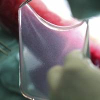Doctors lift up a sheet of skin in a lab at St. Josef-Hospital in Bochum, Germany, Oct. 18. Doctors treating a critically ill boy with a devastating skin disease used experimental gene therapy to create an entirely new skin for him. Boy with rare disease playing again with new gene-edited skin