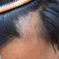 Riken will soon start animal testing of a newly developed method to culture hair follicles for transplantation. Tokyo-backed institute and medicine firm developing alternative method to regrow hair