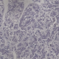 Epithelial cancer cells