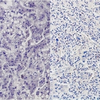 Human liver cancer cells