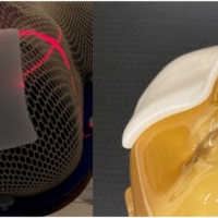 (Left) Receiving radiotherapy with Soft Rubber Bolus on the head. (Right) Shaped for treatment.