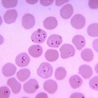 Red blood cells infected with malaria | SYSMEX