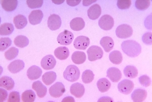 Red blood cells infected with malaria | SYSMEX