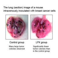 The lung (section) image of a mouse intravenously inoculated with breast cancer cells