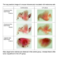 The lung (section) image of a mouse intravenously inoculated with melanoma cells